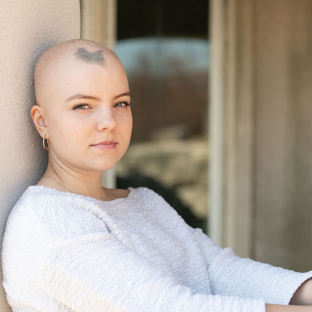 Scalp micropigmentation for alopecia