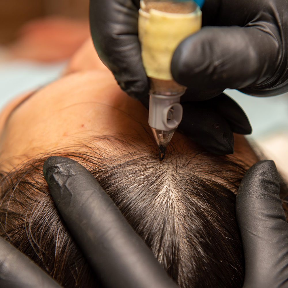 Close up of scalp micropigmentation for women